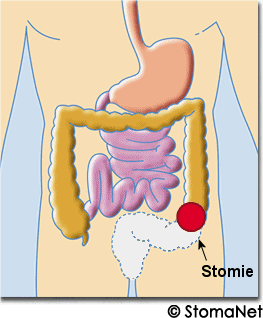 Colostomie