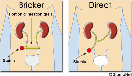 Les stomies urinaires
